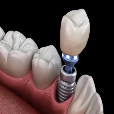 Titanium Alloys in Dentistry Titanium Alloys in Dentistry